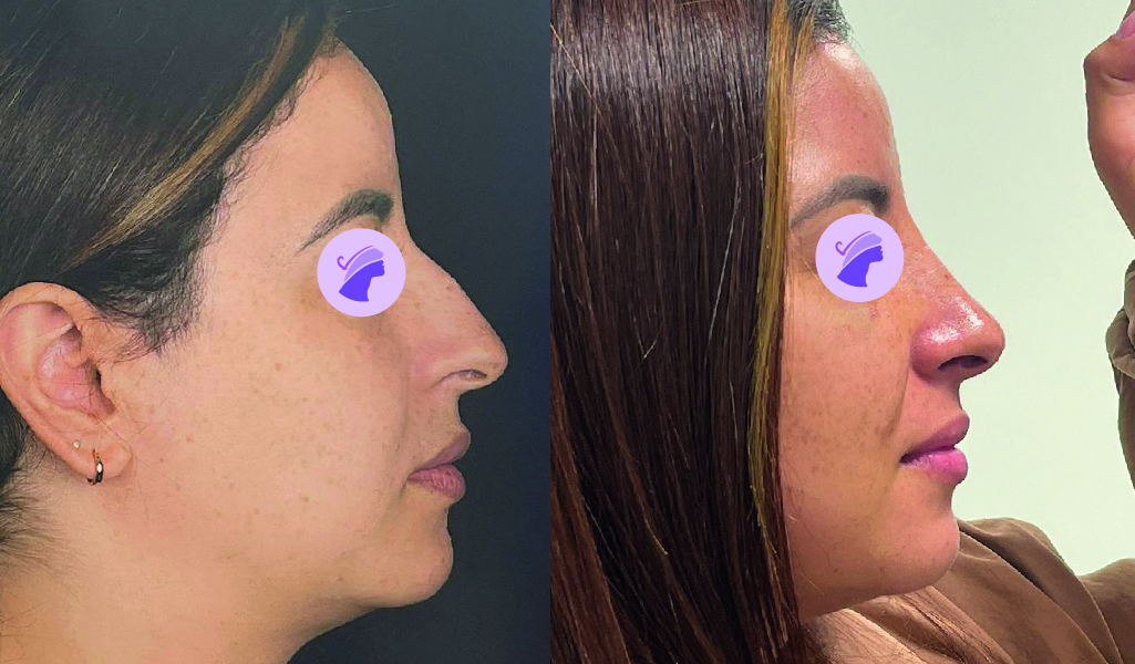 Rinoplastia